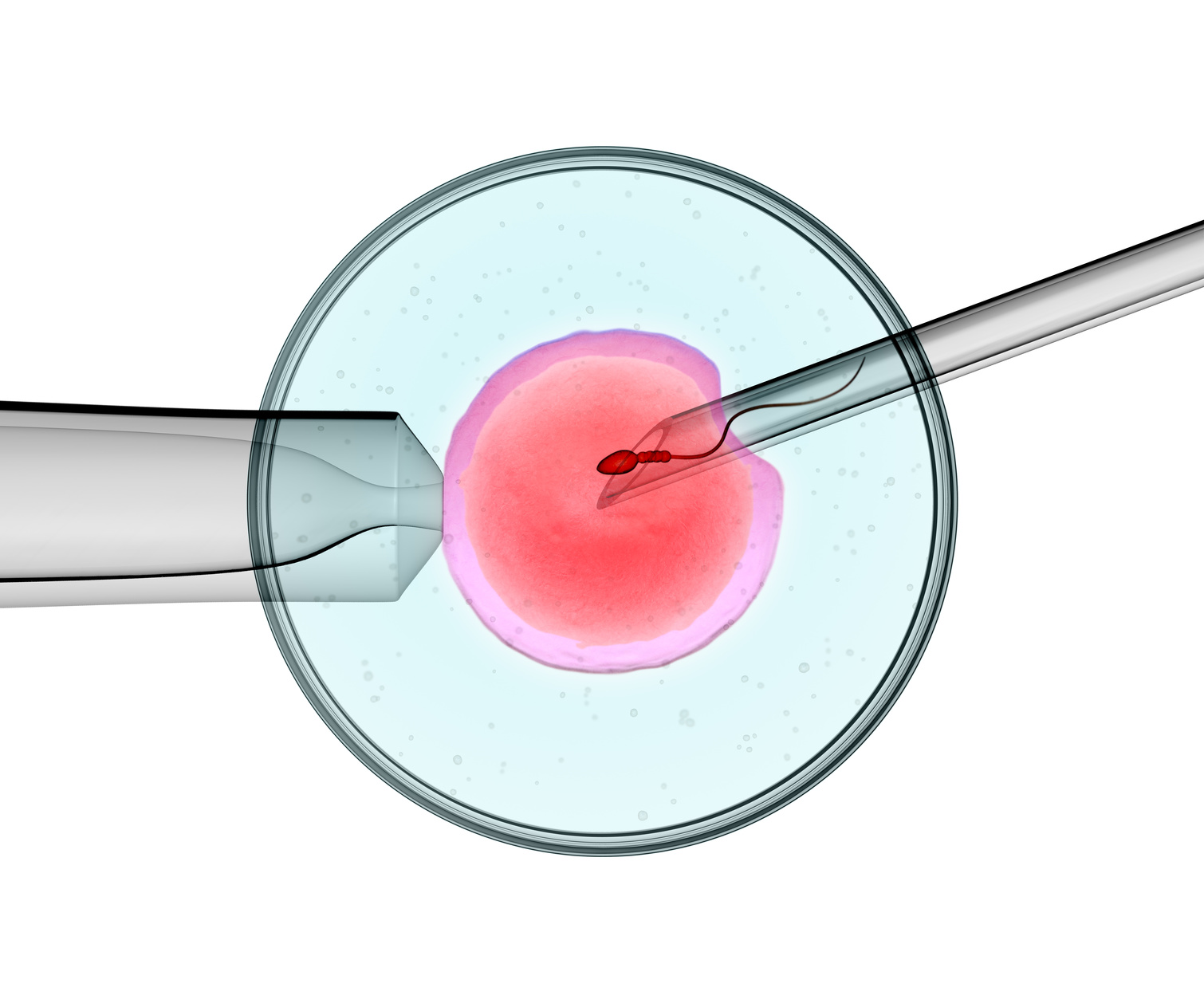 Does ICSI Cause Genetic Defects?